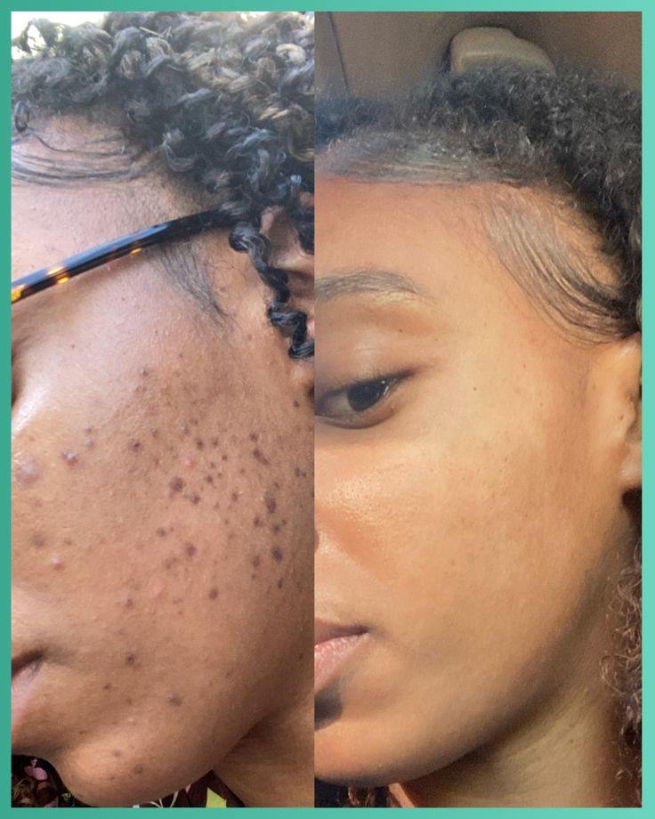 Green Mask Stick – Masque Purifiant & Anti-Points Noirs 🌱